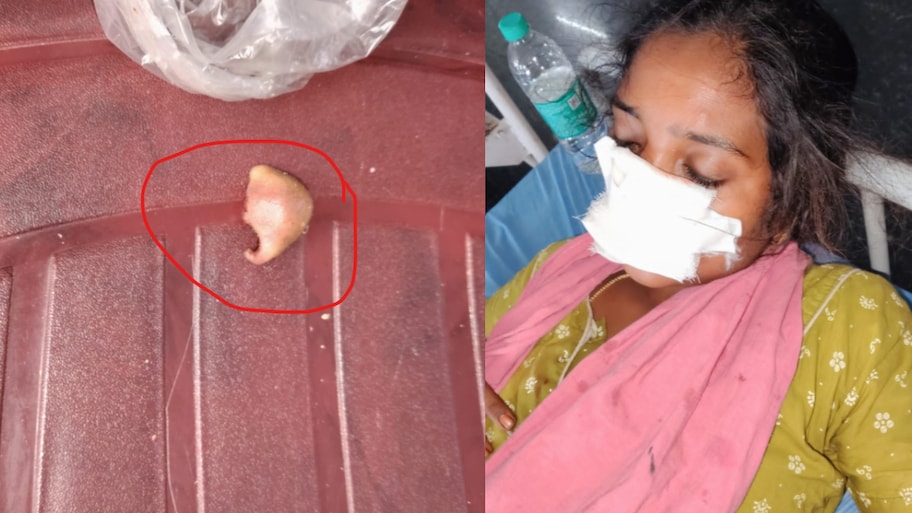 Mancherial: మంచిర్యాలలో ఘోరం.. భార్య ముక్కును కసితిరా కొరికిన భర్త.. అసలేం జరిగిందంటే..?..