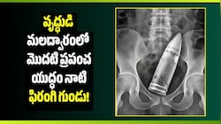వామ్మె.. వృద్ధుడి మలద్వారంలో మొదటి ప్రపంచ యుద్ధం నాటి ఫిరంగి గుండు!