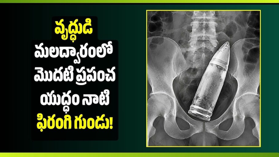 వామ్మె.. వృద్ధుడి మలద్వారంలో మొదటి ప్రపంచ యుద్ధం నాటి ఫిరంగి గుండు!